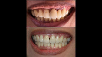 Anterior Bridge (#9-11) Completely Fabricated In-Office by Dr. Rachel Lewin Using CEREC Technology