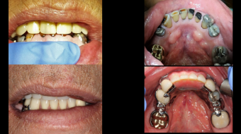 Full Mouth Rehabilitation Including Oral & Periodontal Surgeries, Endodontics, Fixed & Removable Prosthodontics, and Restorative
