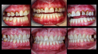 Comprehensive Caries Control using Composite Restorations