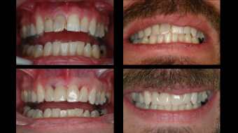 Four Unit Anterior Crowns Fabricated In-Office by Dr. Rachel Lewin Using CEREC Technology