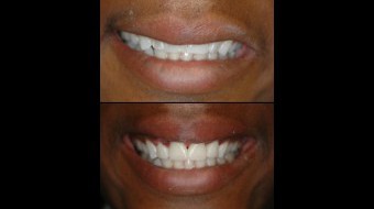 Four Unit Anterior Crowns with Diastema Closure & Soft Tissue Recontouring Fabricated In-Office by Dr. Rachel Lewin Using CEREC Technology