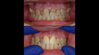 Two Unit Anterior Crowns Fabricated In-Office by Dr. Rachel Lewin Using CEREC Technology (Phase I)