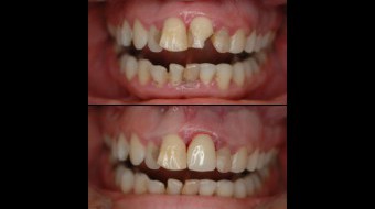 Emergency Visit: Single Unit Anterior Crown Fabricated In-Office by Dr. Rachel Lewin Using CEREC Technology