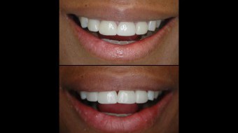 Four Unit Anterior Veneer Replacements Fabricated In-Office by Dr. Rachel Lewin Using CEREC Technology