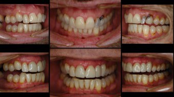 Multi-Unit Anterior Crown & Bridge (#9-11) Completely Fabricated In-Office by Dr. Rachel Lewin Using CEREC Technology