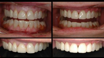 Four Unit Anterior Crowns Fabricated In-Office by Dr. Rachel Lewin Using CEREC Technology